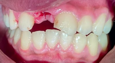 Frontzahntrauma, Avulsion mit trockener Lagerung des Zahnes über 3 Tage