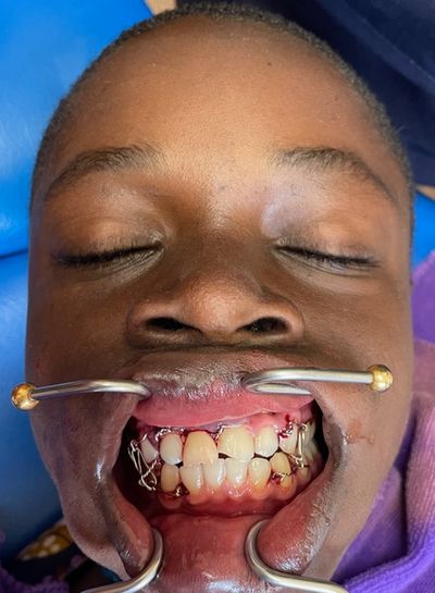 Replantation und Drahtschienung mit intermaxillärer Fixation bei ungünstiger Prognose, durchgeführt von Dr. Elly gegen meinen Rat